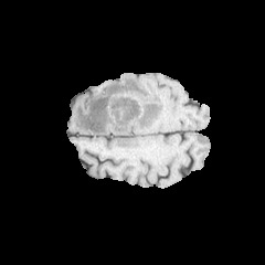 Brain MRI slice used in ReFuSeg tumour segmentation