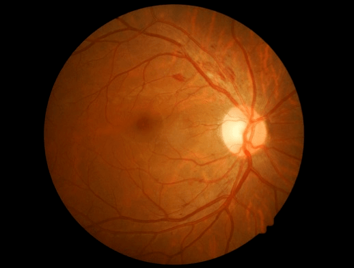 Retinal fundus image used in UATTA-ENS diabetic retinopathy detection
